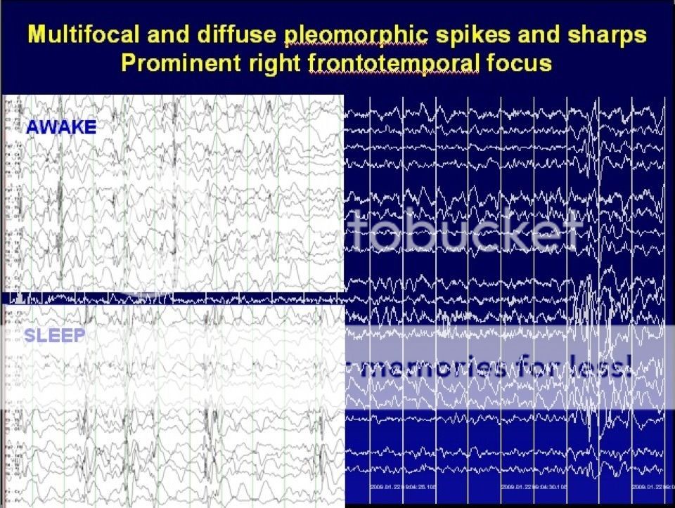 EEG results opinions? BabyCenter